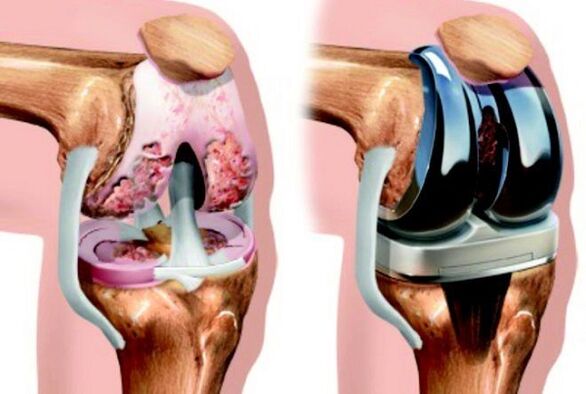 A térdízület endoprostanikája előtt és után az arthrosissal
