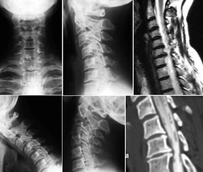 A nyaki gerinc röntgenfelvétele az osteochondrosis diagnosztizálására