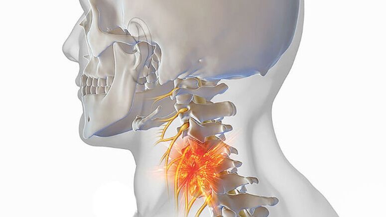 fájdalomforrás a nyaki osteochondrosisban
